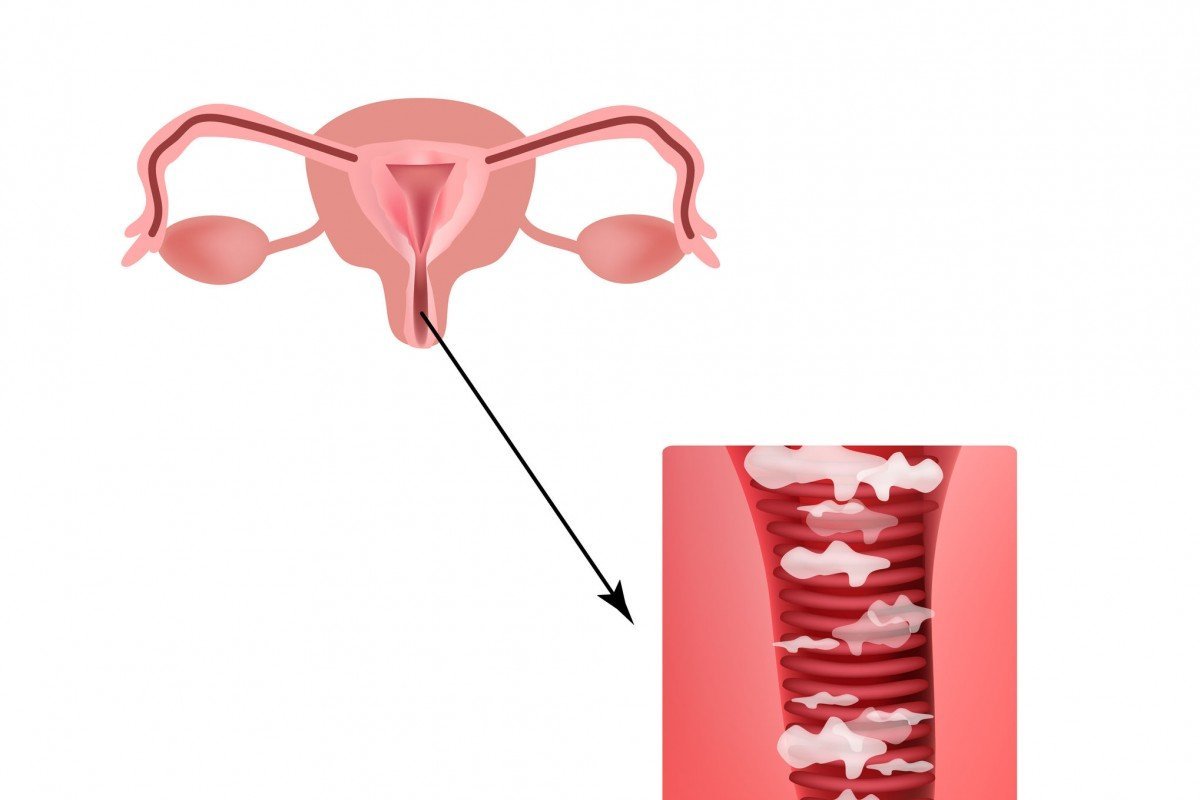 Kenali Dini Tanda-Tanda Vaginitis