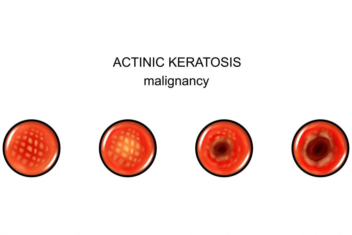 Actinic Keratosis pada Lansia