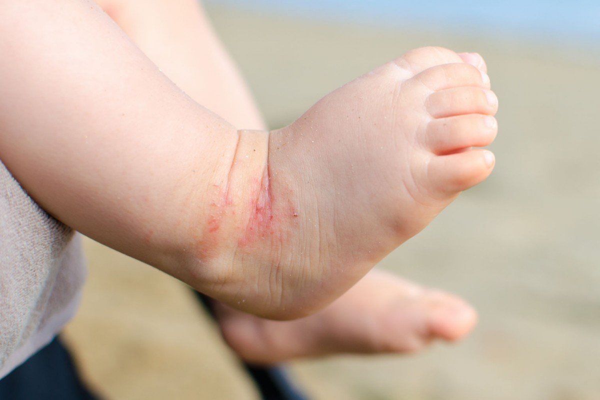 Kulit Bayi Baru Lahir Mengelupas. Apa yang Salah?