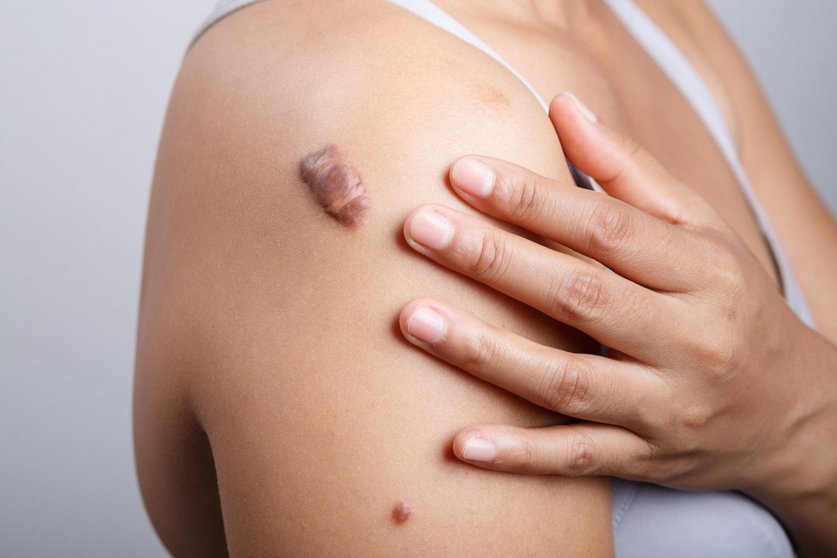 Anda Punya Keloid? Begini Cara Mengatasinya