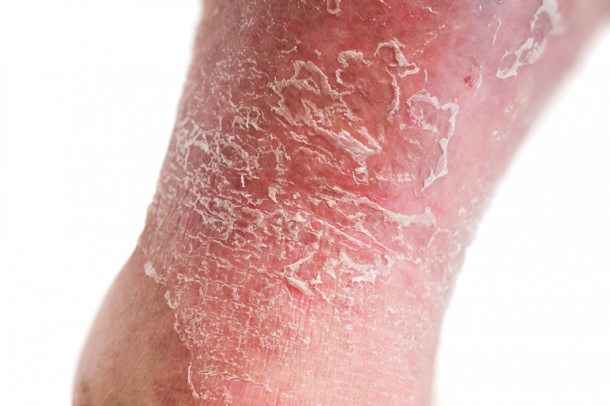Kenali Gejala Psoriasis