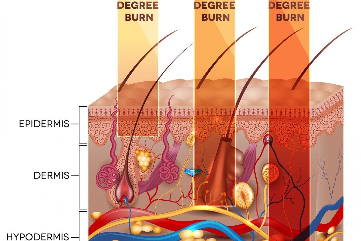 Kulit Terbakar Matahari atau Sunburn Tak Bisa Dianggap Remeh. Ini Cara Mengatasinya.